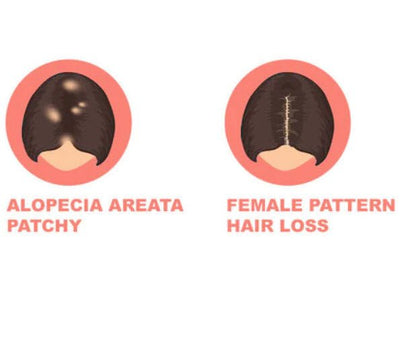 Hair Loss Guide