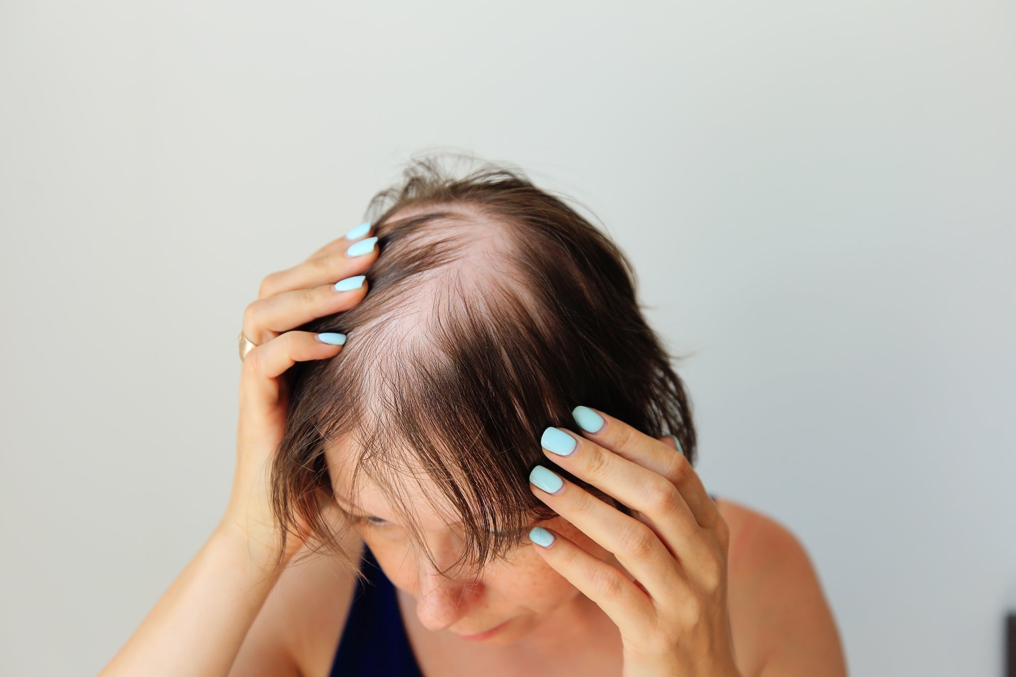 Understanding Hair Loss: 6 Common Causes of Hair Loss - TWC - The Wig Company